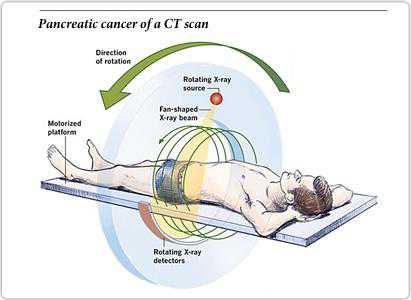 Screening for Pancreatic Cancer