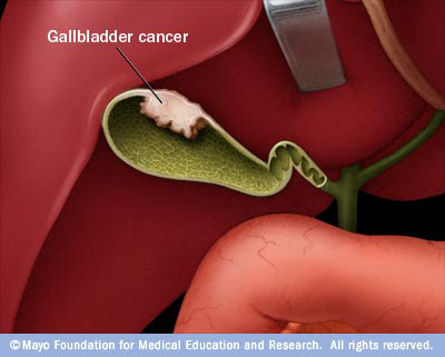 Signs and Symptoms of Gallbladder Cancer